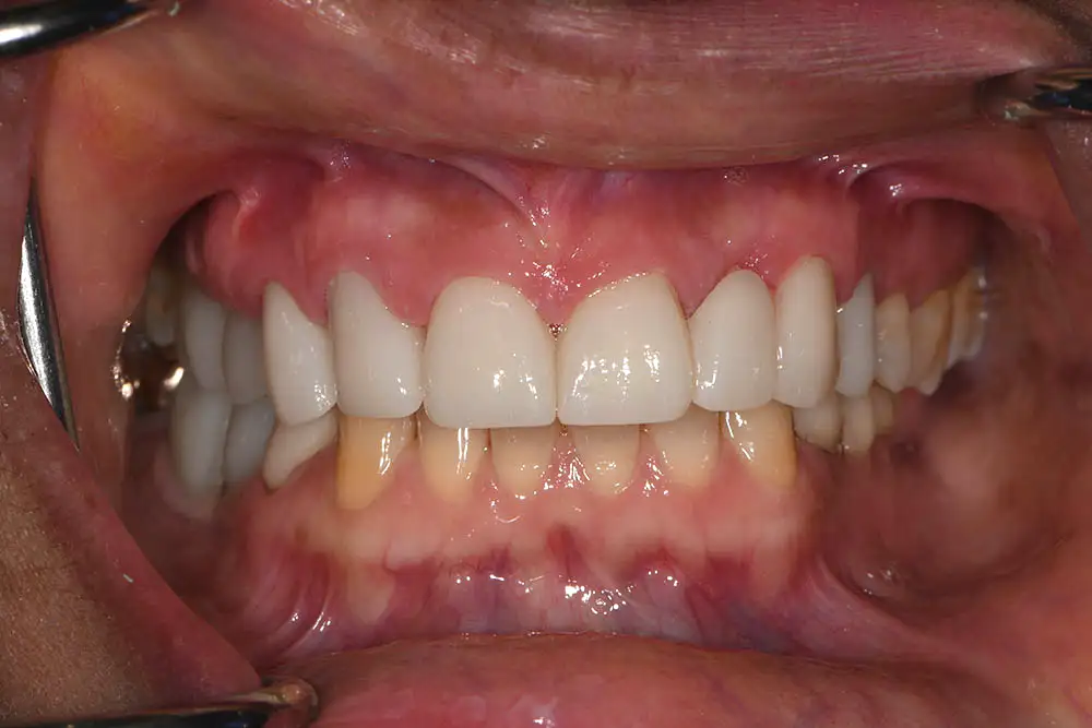 3-after